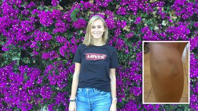 Gebeten op vakantie: 'Zelfs van een lik kun je hondsdolheid krijgen'