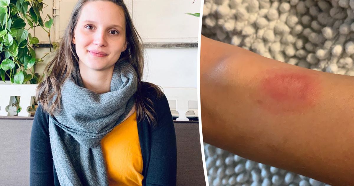 Ellen (25) loopt zware brandwonde op door Fitbit: “Ik werd wakker en voelde mijn arm branden”