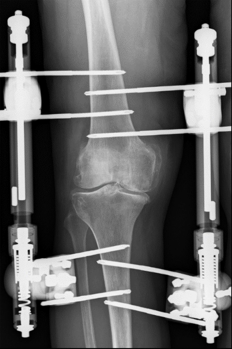 Een nieuwe knie zonder operatie Nederlandse vondst gaat langzaam de wereld rond Medisch