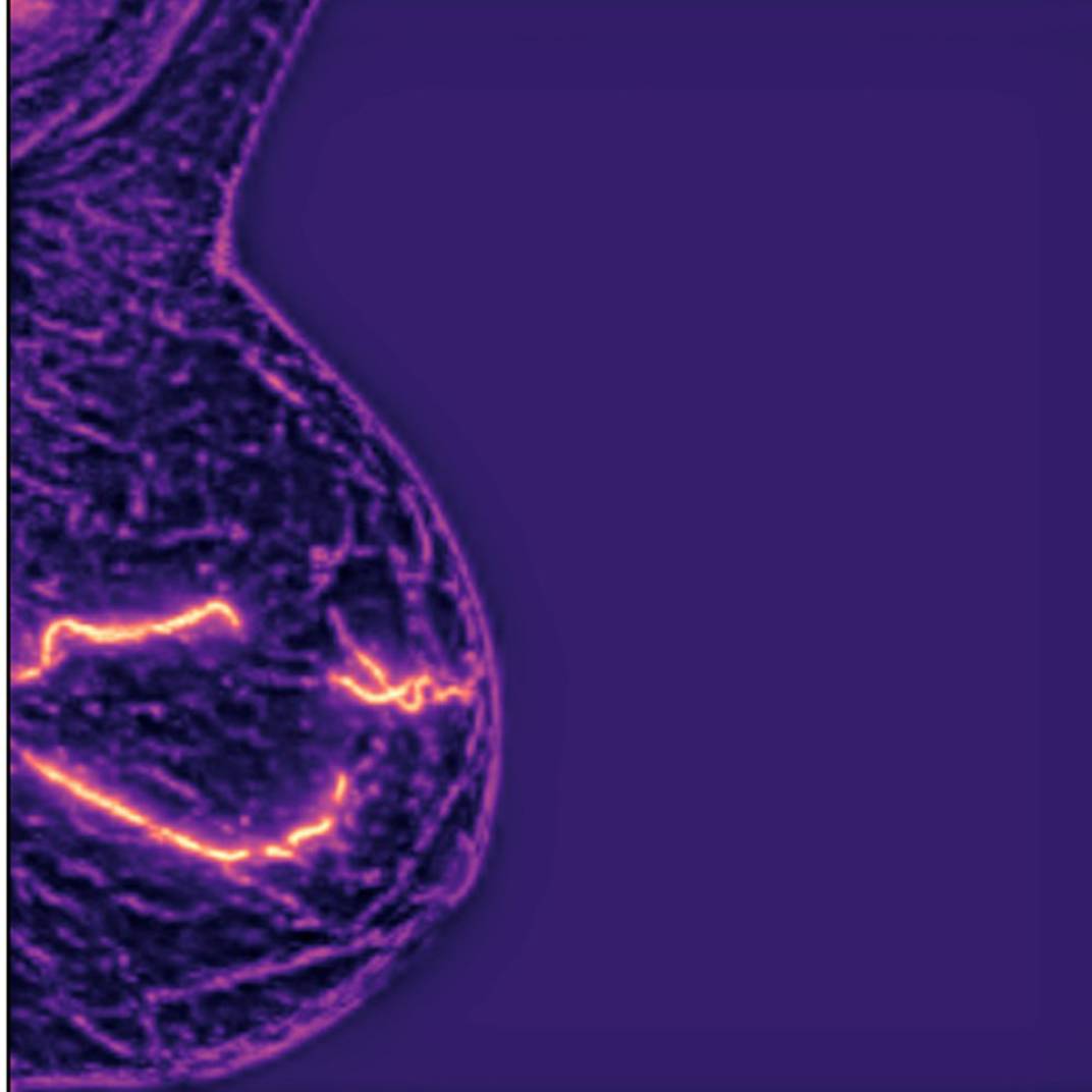 Mammografie krijgt dubbel nut: kleine kalkafzettingen voorspellen hart- en vaatziekten