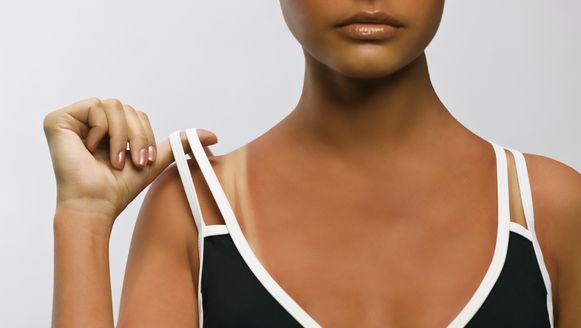 Vier Trucjes Om Je Zonnebrand Te Verbergen Goed Gevoel