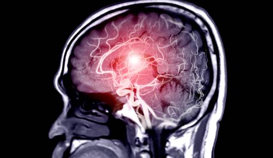 ‘Een bloeding komt het vaakst voor bij jonge mensen en de gevolgen zijn dramatisch’: neurologen over hersenaneurysma