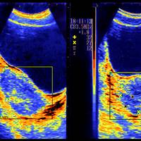 Eén op de tien vrouwen heeft endometriose, maar de diagnose laat gemiddeld zeven tot tien jaar op zich wachten