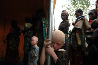 Le corps démembré d'un jeune albinos découvert au Burundi