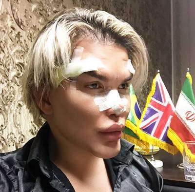 'Faceliftfreak' Rodrigo heeft na tiende operatie eindelijk zijn poppenneusje