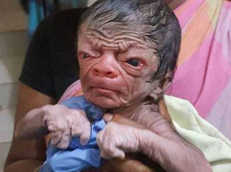 Baby Geboren Met Uiterlijk Van 80 Jarige Fit Gezond Nina Hln