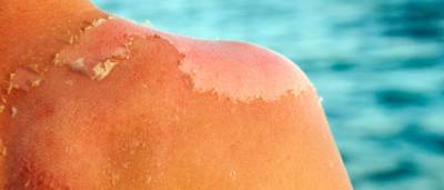 Huidige hitte een hel voor zonneallergiepatiënten