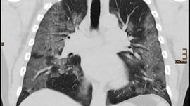 Dit doet het coronavirus met je longen: “Niet uitgesloten dat genezen patiënten later transplantatie nodig hebben”