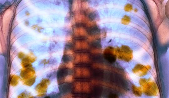 Mogelijk vaccin tegen longkanker in 2030: ‘Grote stap vooruit’