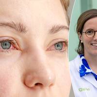 Last van rode ogen? In deze gevallen moet je naar de dokter: ‘Spoel je ogen zeker níét met kraanwater’